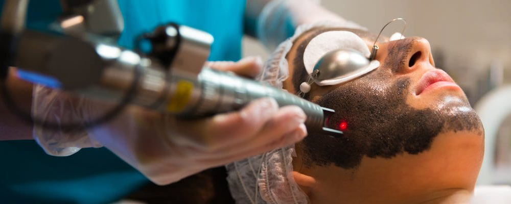 Hollywood Peel (Láser)