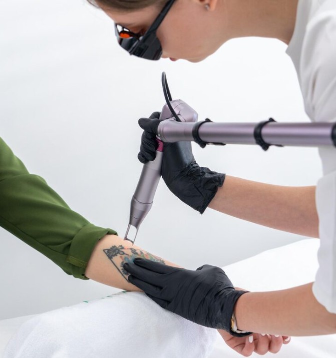 Retirada de tatuajes con láser